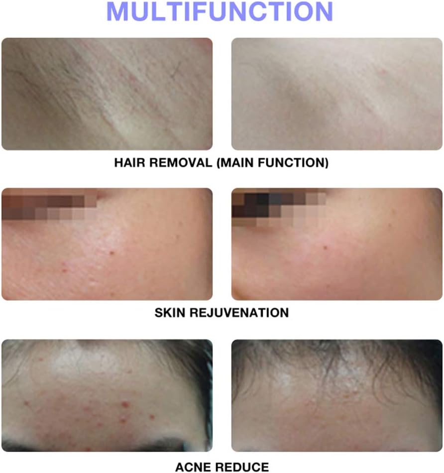 IPL Hair Removal Device Permanent, Painless & Safe for Full Body