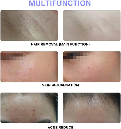 IPL Hair Removal Device Permanent, Painless & Safe for Full Body